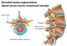 spinal decompression brace